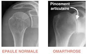 Arthrose de l'épaule - Centre de Chirurgie Orthopédique et Sportive
