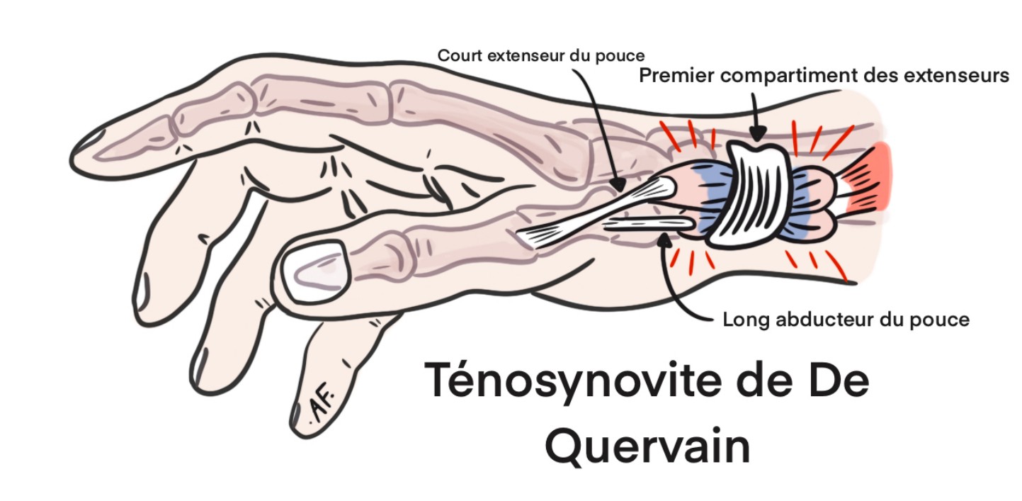 La tendinite de Quervain - Centre de Chirurgie Orthopédique et ...